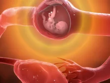 A woman with an ectopic pregnancy